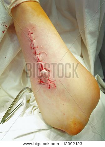 pooperační rány po sešití