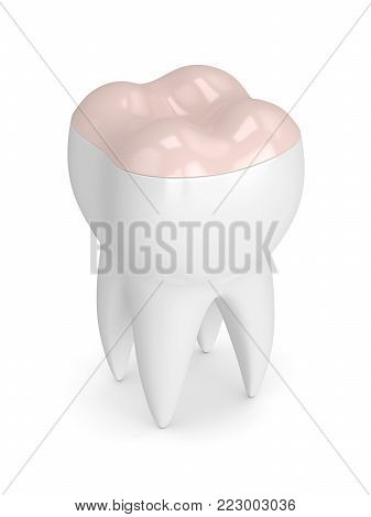 3D Render Of Tooth With Dental Onlay Filling