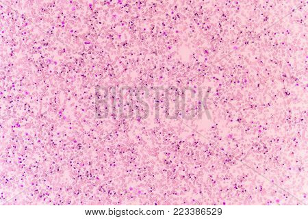 Abnormal red blood cells in Blood smear Thalassemia patient.