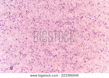 Abnormal red blood cells in Blood smear Thalassemia patient.