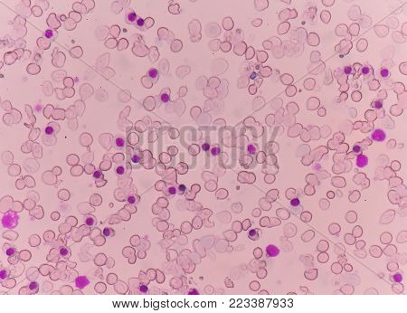 Blood Smear Thalassemia Patient.