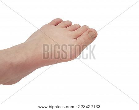Hallux valgus, legs isolated on white, aching joints