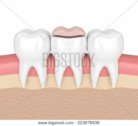 3d render of teeth with dental onlay filling in gums