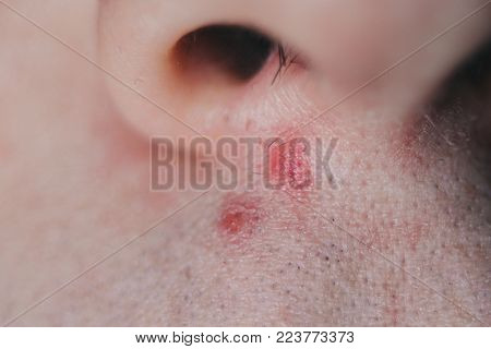 Pimple under the nose of a young man, teenager, teenager, close-up.