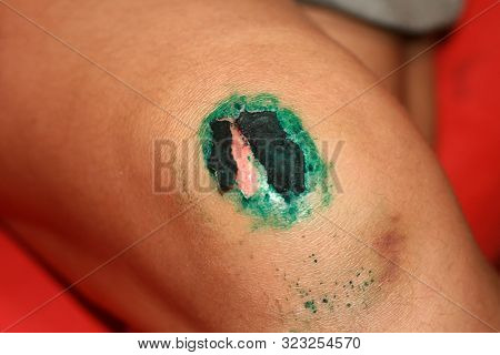 Healing Wound On The Knee. The Wound Treated With Brilliant Green. The Scab Will Climb