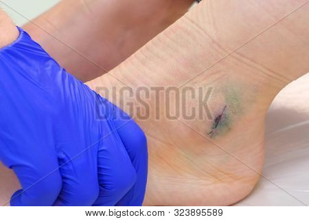 Surgeon Bends And Unbends Patients Leg Checking Mobility Of Ankle Joint After Surgery To Removal Hyg