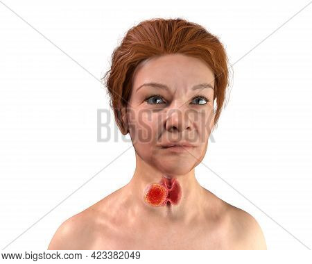 Thyroid Cancer. 3d Illustration Showing Thyroid Gland With Tumor Inside Human Body