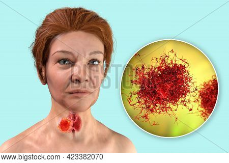 Thyroid Cancer. 3d Illustration Showing Thyroid Gland With Tumor Inside Human Body And Closeup View 