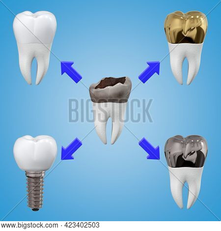 Scheme Of Different Options For Prosthetics Of A Damaged Tooth. Dental Theme. 3d Rendering.