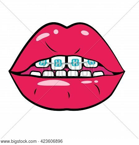 Red Open Mouth With Braces On Teeth