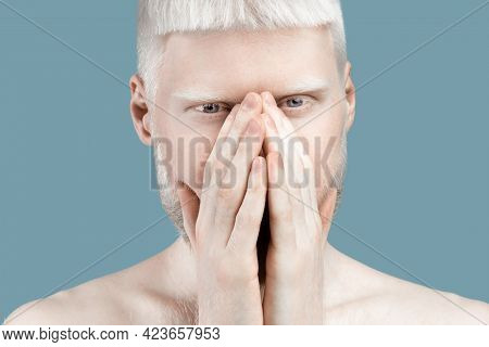 No Way. Albino Guy Covering Mouth With Both Hands And Looking At Camera, Standing Speachless Over Bl