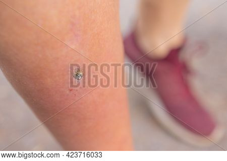 Pimple Folliculitis On Buttock Caused By Infection From Bacteria, Yeast, Fungus, Irritation Of Hair 