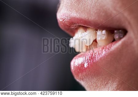 Close Up Of Smiling Woman With Opened Mouth Demonstrating White Teeth With Orthodontic Brackets. Fem