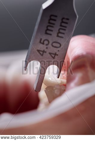 Dental Height Gauge. Macro Photography. Vertical Close-up Snaphot Of A Dental Measuring Tool, Teeth 