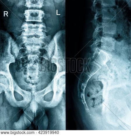 Pelvic Bones Two Positions Check Roentgenogram Black Background