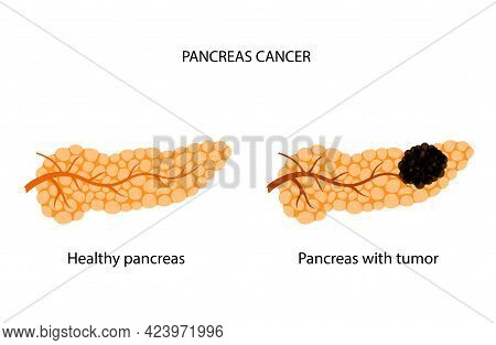 Pancreatic Cancer Logo. Pancreas With Tumor And Healthy Organ. Medical Appointment And Treatment. Pa