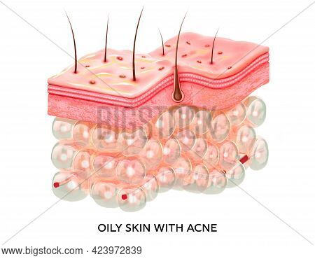 Oily Skin With Acne. 3d Illustration Of The Structure Of The Skin Layers Microstructure.medical And 