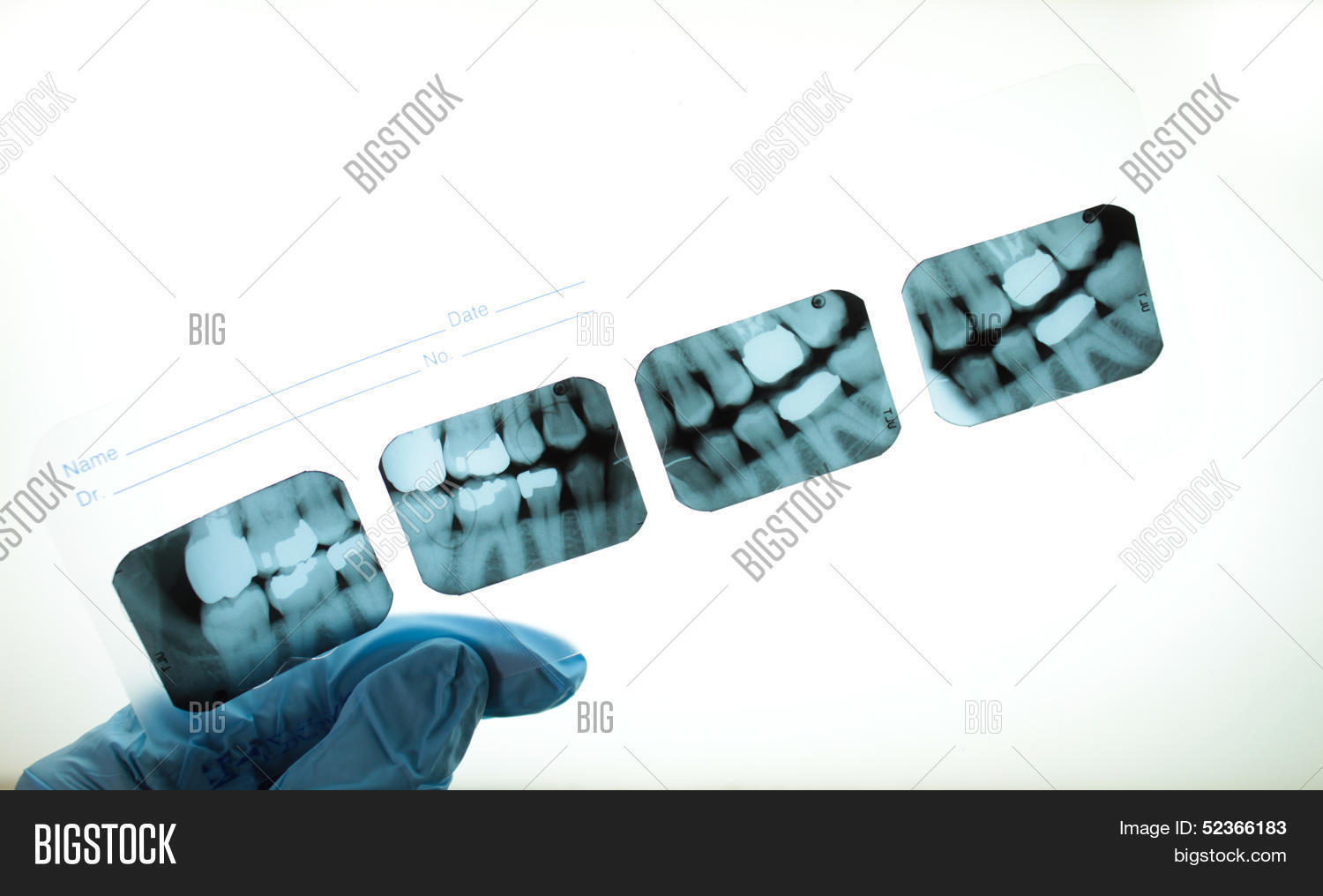 Dental Bitewing Xrays Image & Photo (Free Trial) Bigstock