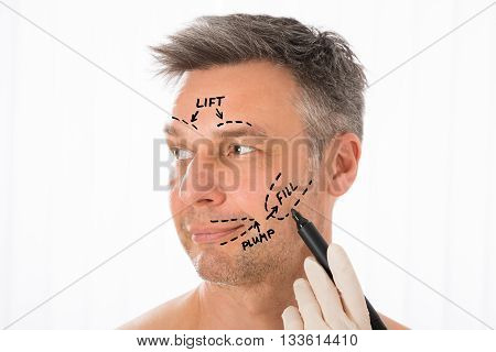 Close-up Of Surgeon Hands Drawing Correction Lines On Man Face With Marker