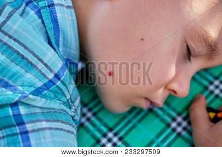 Vascular Hemangioma Boy Cheek. Sad Grim Child. Concept: Medicine, Childhood Diseases