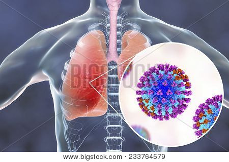 Flu Viruses In Human Lungs, 3d Illustration Showing Anatomy Of Human Respiratory System And Close-up