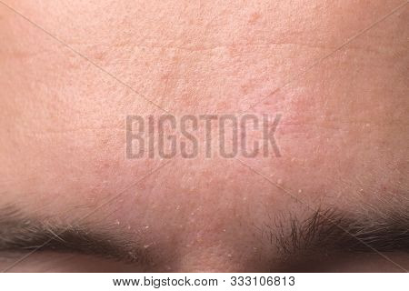 Weeping Eczema In The Stage Of Exudation. Closeup Of Forehead Area With Eczema Rash Clinic