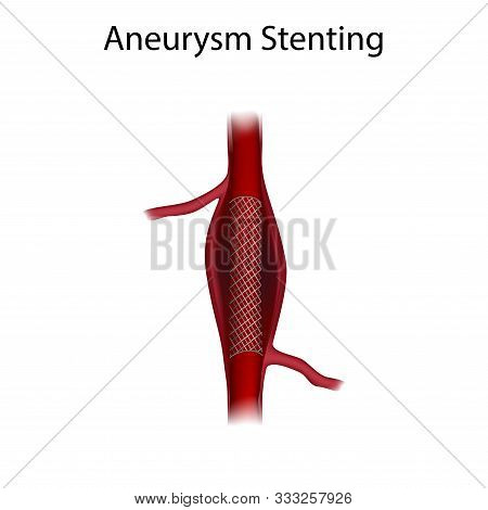 Aneurysm Repair With Stenting. Medical Anatomy Illustration.