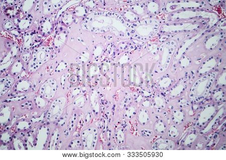 Histopathology Of Hypertensive Renal Disease, Light Micrograph, Photo Under Microscope