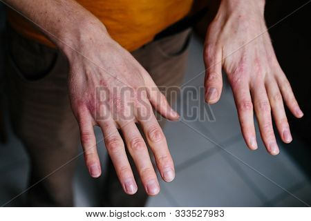 High Angle View Of Hands Suffering The Dryness On The Skin And Deep Cracks On Knuckles. Eczema Or Ps