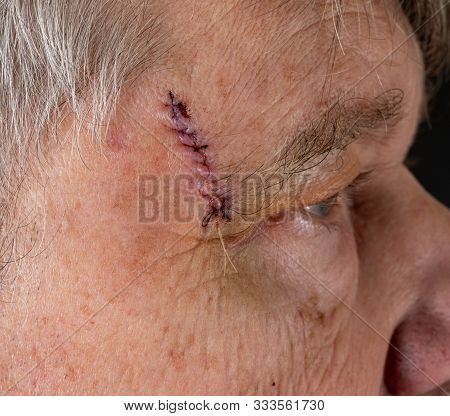 Senior Adult Male With Stitches In The Cut After Surgery For Removal Of Basal Cell Carcinoma Caused 