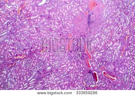 Histopathology Of Hypertensive Renal Disease, Light Micrograph, Photo Under Microscope