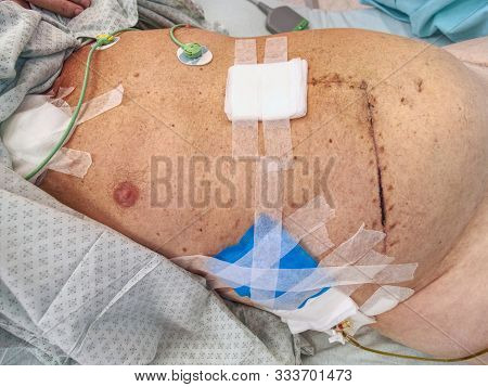 Fresh Postoperative Scar Sewn With Silver Thread. Patient After Intestinal And Gall Bladder Cancer.