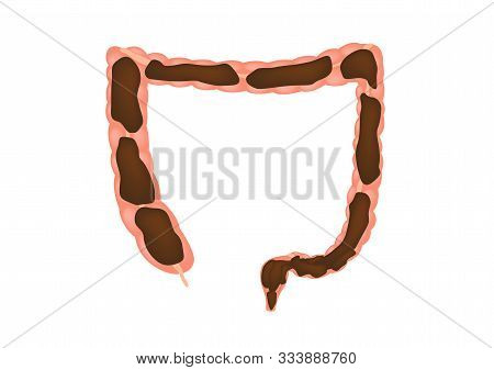 Constipation In Intestine / Colon Vector / Human Stomach