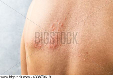 Skin Infected Herpes Zoster Virus. Herpes Virus On Body. Urticaria Rash. Atopic Dermatitis On Body.