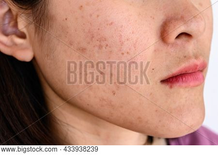 Side View Close-up Of Woman Face Has Variety Problems On Her Skin (such As Acne, Pimple, Pores And M