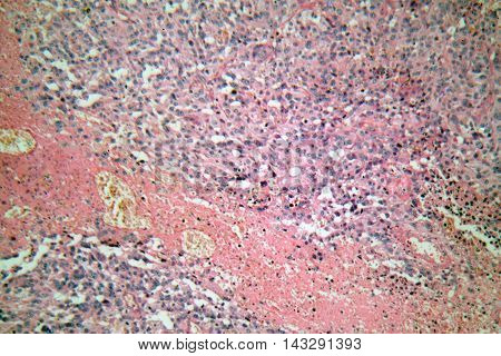 Cells of a human skin with melanoma (skin cancer) cells under a microscope.