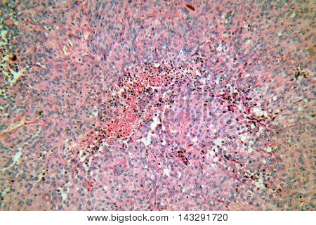 Cells of a human skin with melanoma (skin cancer) cells under a microscope.
