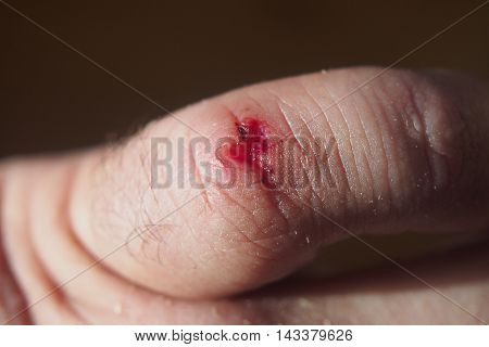 Trauma thumb. The fresh wound on his little finger.