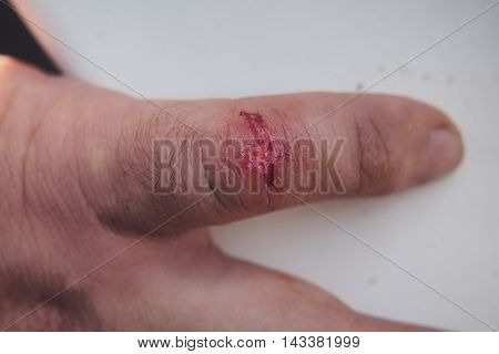 Trauma thumb. The fresh wound on his little finger.