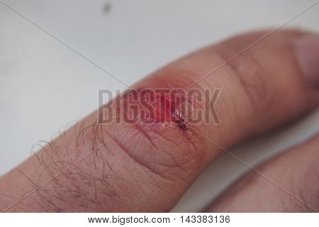 Trauma thumb. The fresh wound on his little finger.