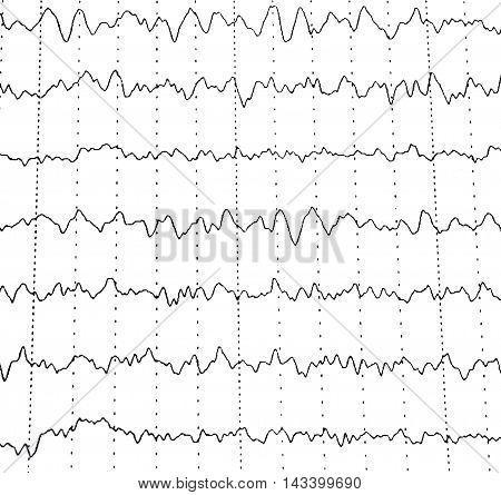 Electroencephalography test that shows electrical activity of the brain.