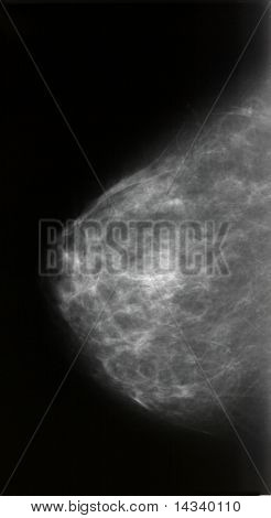Mammography