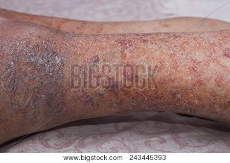 Close-up Of Skin With Varicose Veins On Senior Male Leg. Concept Of Dry Skin, Old Senior People, Var