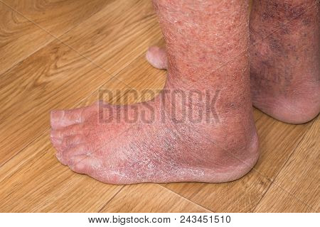 Close-up Of Skin With Varicose Veins On Senior Male Leg. Concept Of Dry Skin, Old Senior People, Var