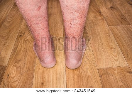 Close-up Of Skin With Varicose Veins On Senior Male Leg. Concept Of Dry Skin, Old Senior People, Var