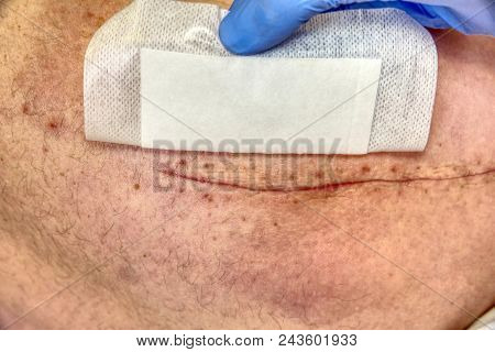 Replacing Of The Devastated Hip Joint For The Hip Endoprosthesis. Selective Focus Of Human Leg With 