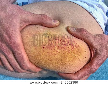 Bruised Wound Injury On Human Body. Patient Show Injured Body With Large Paintful Hematoma.