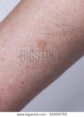 Skin Complexion Discoloration, Hyperpigmentation Skinblemishes Close Up. Dermatology, Health Concept