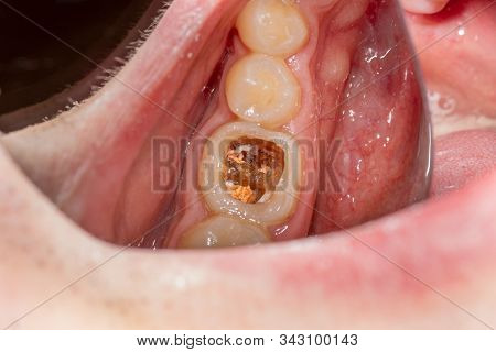 Dental Caries. Filling With Dental Composite Photopolymer Material Using Rubber Dam. The Concept Of 