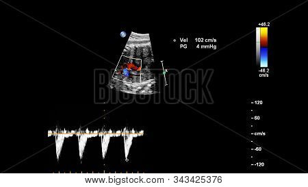 Ultrasound Screen With Fetal Echocardiography.